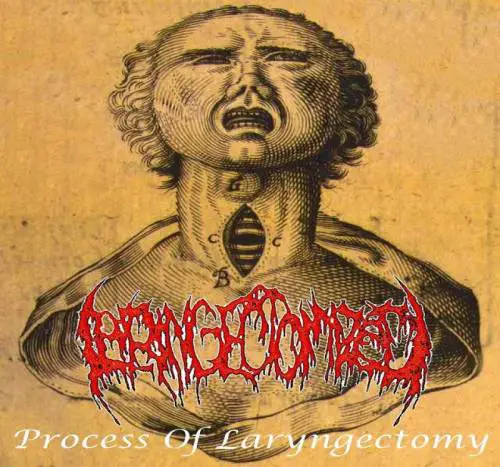 Laryngectomized : Process of Laryngectomy